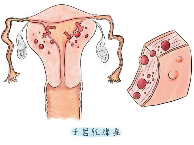 子宮腺肌癥